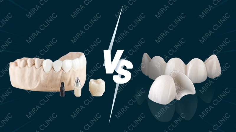 Veneers vs Crowns vs Composite Bonding